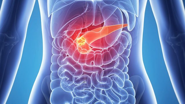 Pancreatic cancer render